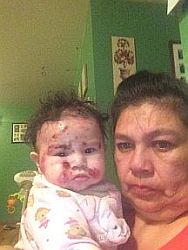 This is a photograph of a woman and child.  The child has a large number of sores and scabs on their face.