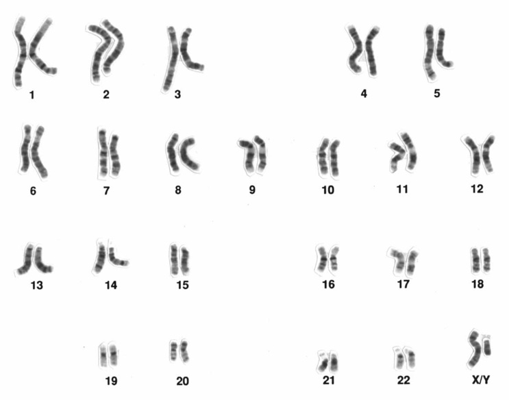 This is an image of a karyotype showing chromosomes that have been paired up with matching chromosomes. The chromosomes appear as rod-shaped strands of different lengths with light and dark grey banding along their length. The chromosome pairs are arranged neatly into four rows. Below each pair is a number.  The top row have pairs numbered 1 to 5, the second row has pairs numbered 6 to 12, the third row has pairs labelled 13 to 18, and the last row has pairs labelled 19 to 22. The last pair on the right has the label ‘X/Y’ below it.  The grey coloured chromosomes are on a white background.