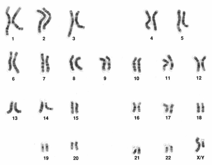 This is an image of a karyotype showing chromosomes that have been paired up with matching chromosomes. The chromosomes appear as rod-shaped strands of different lengths with light and dark grey banding along their length. The chromosome pairs are arranged neatly into four rows. Below each pair is a number.  The top row have pairs numbered 1 to 5, the second row has pairs numbered 6 to 12, the third row has pairs labelled 13 to 18, and the last row has pairs labelled 19 to 22. The last pair on the right has the label ‘X/Y’ below it.  They grey coloured chromosomes are on a white background.