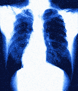 This is an animated gif of a human chest x-ray. Just the torso is visible. The lungs can be seen in dark blue and are expanding and deflating rhythmically.