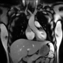 This is an animated gif of a real MRI showing a subject from the waist up to the neck. The internal organs such as the liver and stomach can be seen rising and falling due to the action of the diaphragm and the expanding lungs. The chest cavity expands and the rib cage can be seen lifting up and out as the volume increases in the chest cavity. The beating heart is visible in the centre of the image.