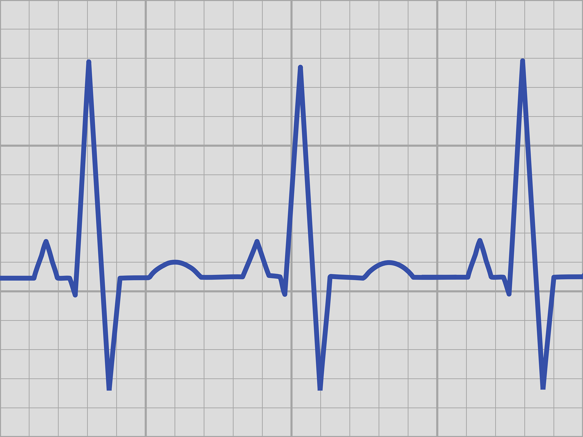 This is an image of a piece of grey graph paper with a blue line running horizontally across it. From left to right, the blue line has a small peak up, then a large peak up, and then a peak down, followed by a small dome shape peak up. This repeats two more times across the graph paper.