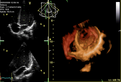This is an animated gif showing the opening and closing of heart valves. On the right of the image is an orange coloured image with the valve in the centre opening and closing in a rhythmic pattern. On the left of the image is two black and white images, with one above the other. Each shows the side view of a valve with the flaps opening upward in a rhythmic pattern.