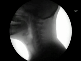 This is an animated gif of an x-ray showing a human swallowing. Only the side of the head and the neck is visible. The animation shows the person chewing and then swallowing, and the food can be seen travelling down the throat.