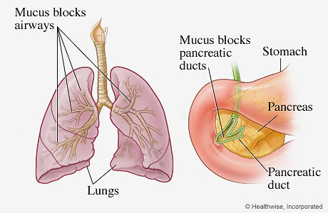This is a diagram showing a set of lungs and trachea on the left and a close up of the pancreas where it connects to the duodenum on the right. The label ‘lungs’ is below the left image and the label ‘mucus blocks airways’ in the left-top corner has lines pointing to the network of bronchial tubes visible in the lungs. The image on the right has the section of the stomach and pancreas labelled as such. A green tube linking the pancreas and the duodenum attached to the left side of the stomach is labelled as ‘pancreatic duct’. A label to the top-right of this image reads ‘Mucus blocks pancreatic ducts’ and an arrow from the label points to where the duct connects to the duodenum.