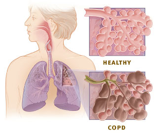 This is a diagram showing a woman from the waist up and her head turned to the left. Superimposed on the image is the respiratory system including the facial cavities, trachea, and lungs. To the left are two square images, one above the other. The top image is labelled ‘Healthy’ and depicts a cluster of pink alveoli that resembles a bunch of grapes. In the image below, labelled ‘COPD’, is the same image.  However, ten or more of the alveoli are enlarged and brown in colour.