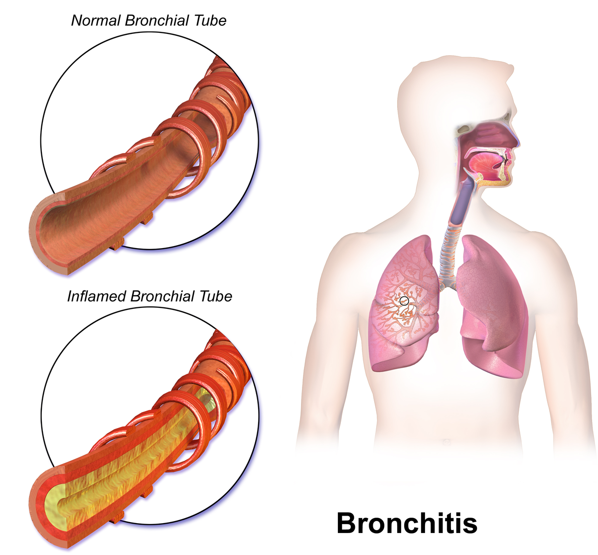 This is a diagram of a male shown from the waist up and the head turned to the right. Superimposed on the image is the respiratory system, including the facial cavities, trachea, and lungs. In addition, the tongue and teeth are visible. The label ‘Bronchitis’ is written below the man. To the left are two images in circles, one above the other. The top circle is labelled ‘Normal Bronchiole Tube’ at the top. The image in the circle shows a brown tube that is hollow and ringed structures are around it. The lower circle is labelled ‘Inflamed Bronchial Tube’ above it. The image is the same as in the circle above, however the inner layer of the tube is red and it is filled with a yellow substance. 
