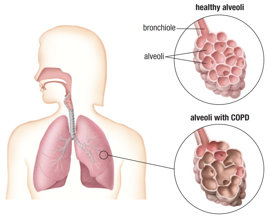 This is a diagram showing a woman from the waist up and her head turned to the left. Superimposed on the image is the respiratory system including the facial cavities, trachea, and lungs. To the left are two round images, one above the other. The top image has the label ‘healthy alveoli’ above it. In the circle is a cluster of pink-coloured alveoli that resembles a bunch of grapes. A label to the left points to two of the round alveoli labelling them as such. On the top of the cluster of alveoli is a pink tube labelled ‘bronchiole’. The image in the circle below is labelled ‘Alveoli with COPD’. This one has the same image as the circle above.  However, most of the avelio are brown in colour. The walls between some of the alveoli are missing, creating larger sacs.